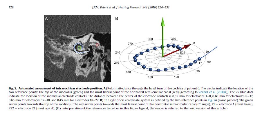CROSSSD_'s tweet image. Electro-acoustic pitch matching experiments in patients with single-sided deafness and a cochlear implant bit.ly/2vRjP2B. Peters et al (2016), explore mismatch, correlate it to performance, and discuss possible clinical consequences. #CochlearImplant #PitchMatch #SSD