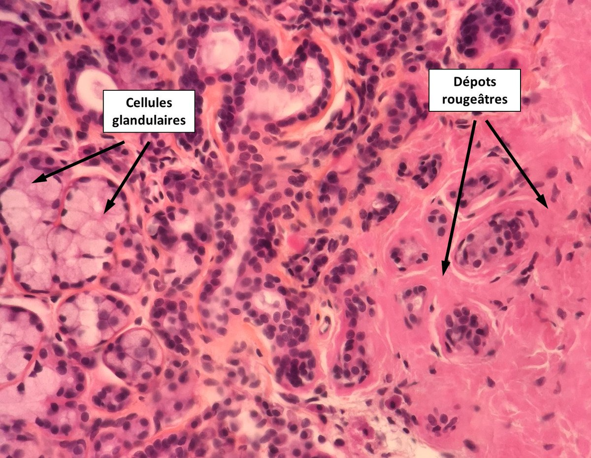 2cAnapath's tweet photo. Dépots amyloïdes extracellulaires témoignant d'une amylose à chaines légères dans le cadre du myélome de la patiente. Ils sont colorés par le rouge congo et la bi-réfringence jaune/vert en lumière polarisée est caractéristique. https://t.co/sKyqqqpN1t