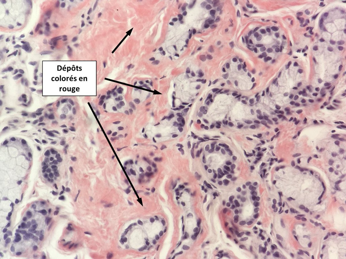 2cAnapath's tweet photo. Dépots amyloïdes extracellulaires témoignant d'une amylose à chaines légères dans le cadre du myélome de la patiente. Ils sont colorés par le rouge congo et la bi-réfringence jaune/vert en lumière polarisée est caractéristique. https://t.co/sKyqqqpN1t