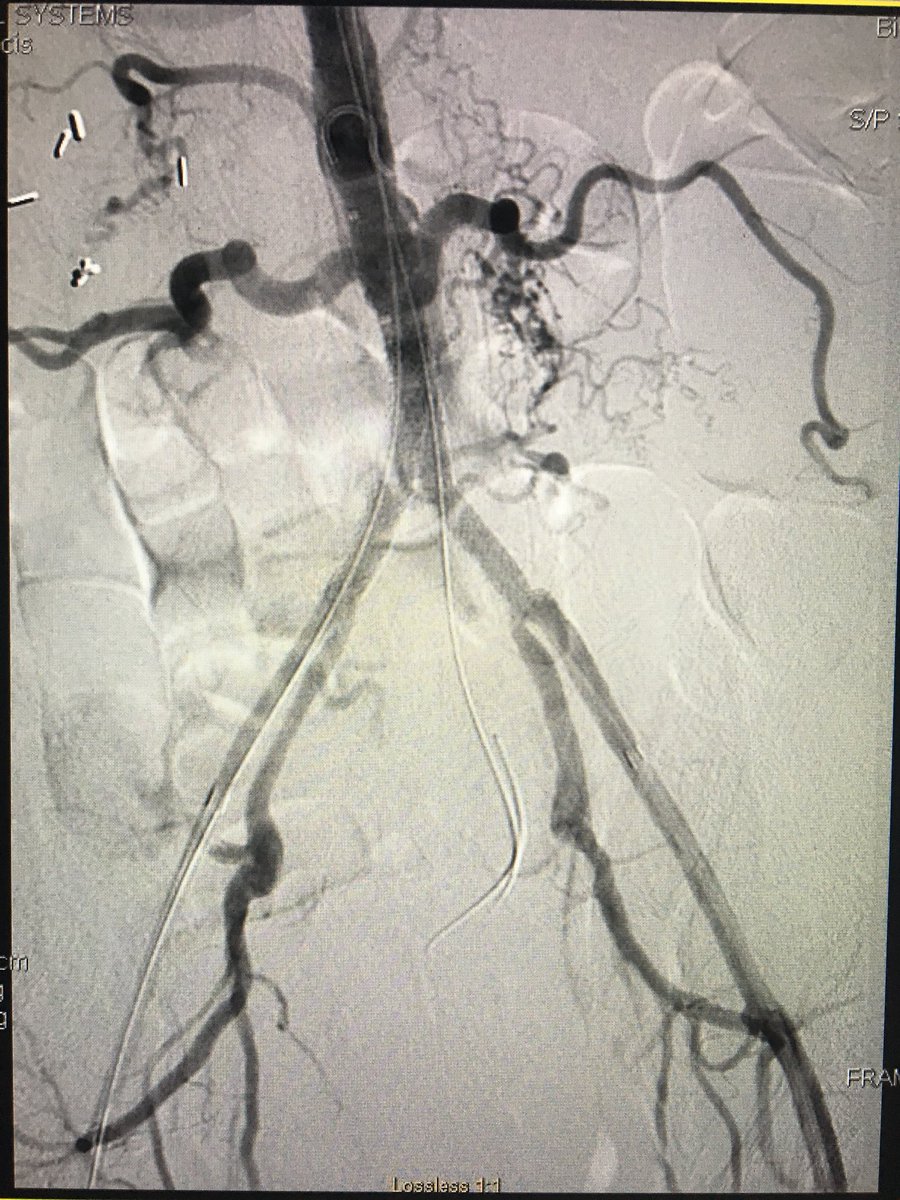 Chronically occluded distal aorta &amp; b/l common iliac arteries. Subintimal arterial flossing w/ antegrade-retrograde intervention (SAFARI), recan, &amp; distal aorta + b/l kissing stents in b/l common iliac arteries. <a href="/SIRRFS/">SIR RFS</a> <a href="/SIRspecialists/">Society of Interventional Radiology</a> <a href="/JVIRmedia/">JVIR</a> #TwittIR #IRad