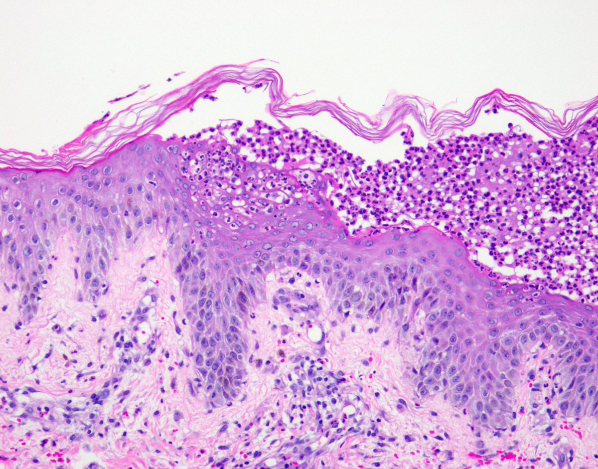 generalized pustular psoriasis histopathology vörös folt viszket a bőrön