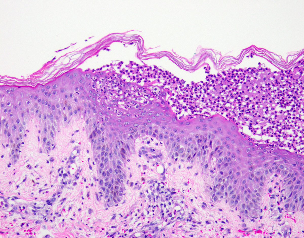 pustular psoriasis pathology)