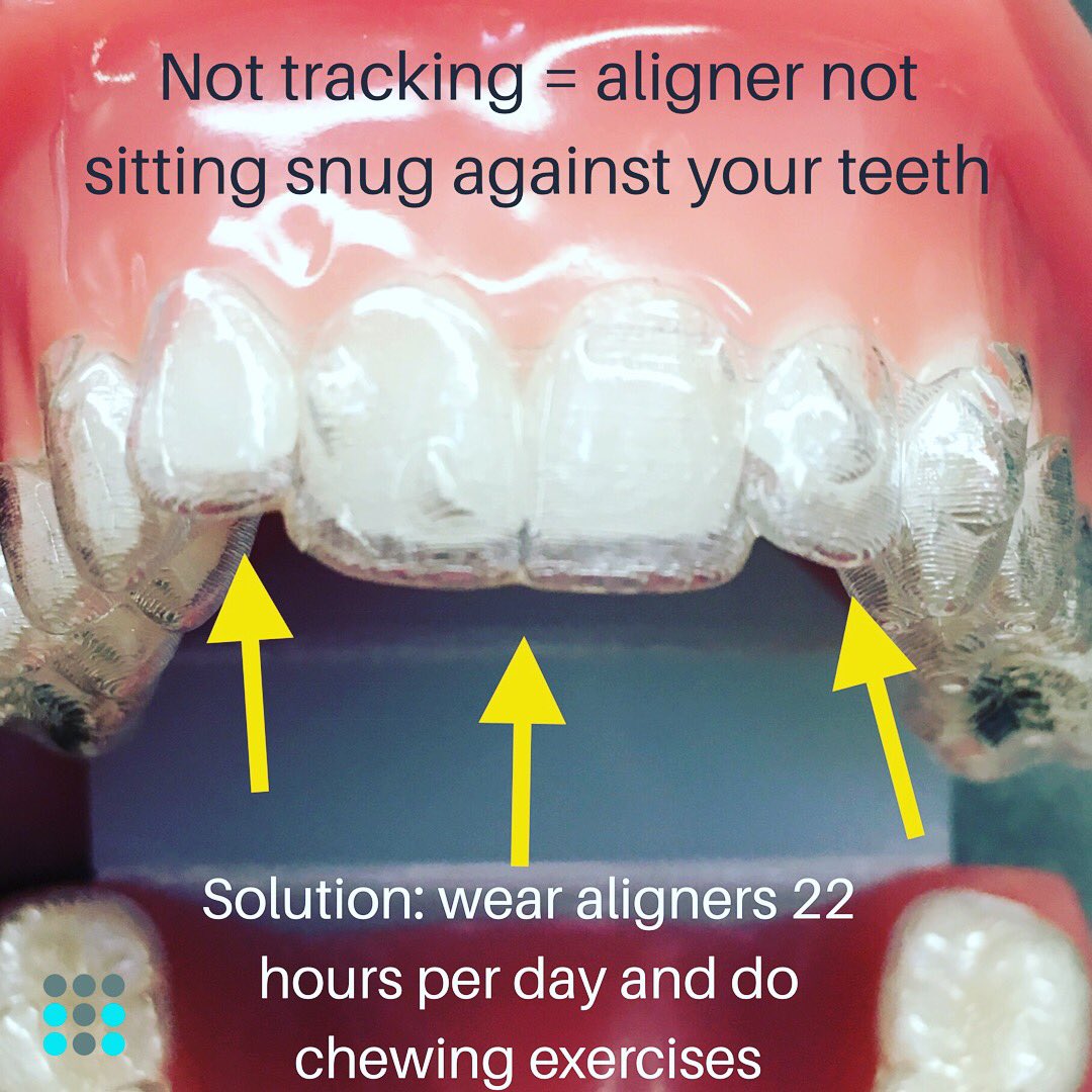 TrayMinder's tweet photo. Are your teeth not tracking? Avoid #refinements by wearing your #aligners 22/7 and doing your chewing exercises. Sometimes despite your best effort, one or more teeth may not “track” and will need additional help. Have you had tracking issues with before? https://t.co/R11jUMsute