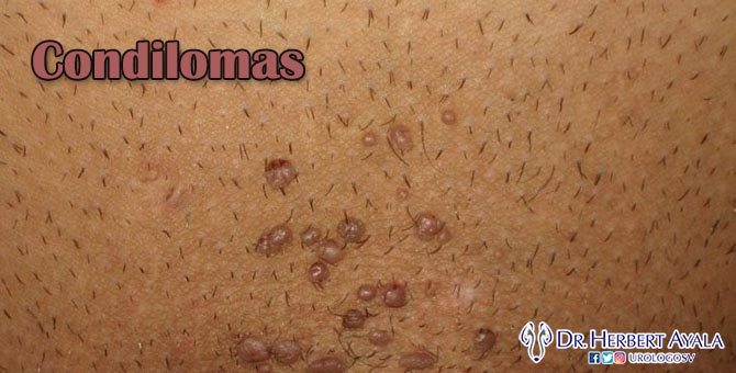 UrologoSV's tweet photo. Verrugas genitales https://t.co/wir17oqMur https://t.co/c2CoxLylTE