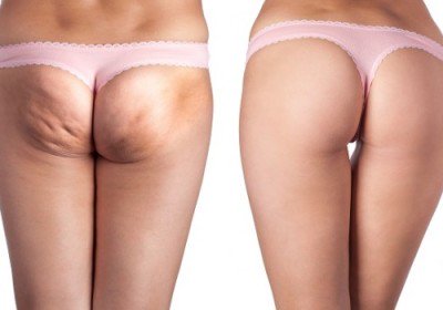 modaedintorni's tweet photo. Scopri 5 rimedi efficaci per combattere la cellulite --->https://t.co/8iAyNSf7SI
#cellulite #ritenzioneidrica #9Ago #rimedi #rimedinaturali #estate #buondì #buongiorno #perderepeso #dimagrire #dieta #alimentazione #slimcup #coppettaanticellulite #acquagym #alimentazionecorretta https://t.co/rahh0pm07U