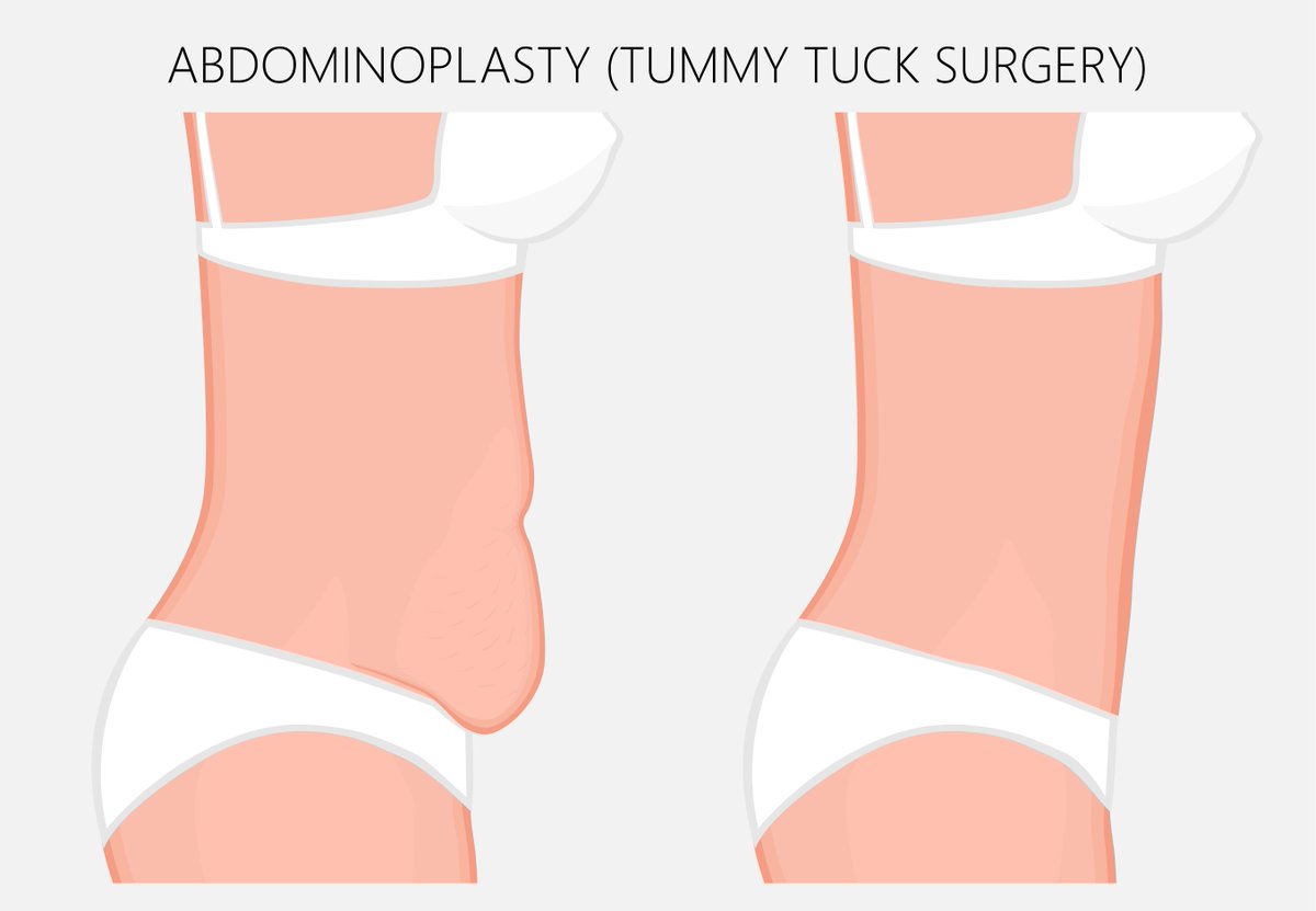 drmounir's tweet photo. The 'mini' #TummyTuck (or partial #abdominoplasty) is for men and women who have a small amount of abdominal skin to be removed and do not have a significantly protruding abdominal muscle wall. Learn more here https://t.co/22Jypj6wdF https://t.co/PARQ4DJqU8