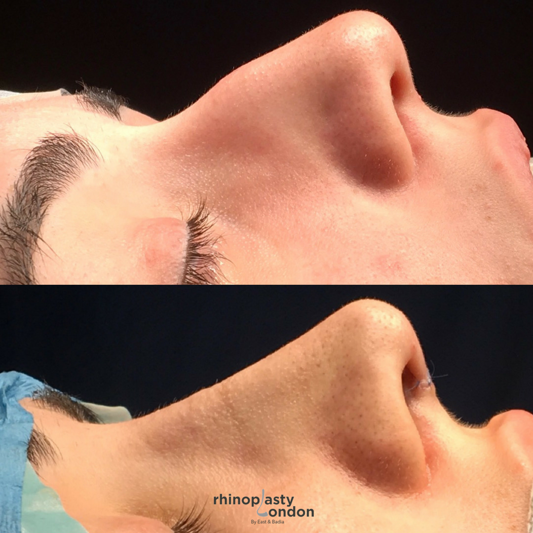 rhinoplastylond's tweet photo. Sixteen on wards is a good age for a female nose job - it’s important that the patient is at nasal maturity and can make an active informed decision regarding surgery. She chose Rhinoplasty London to create her beauty.
#diamondrhinoplasty #piezotechnology #Nobruising https://t.co/O76OZBWNVB