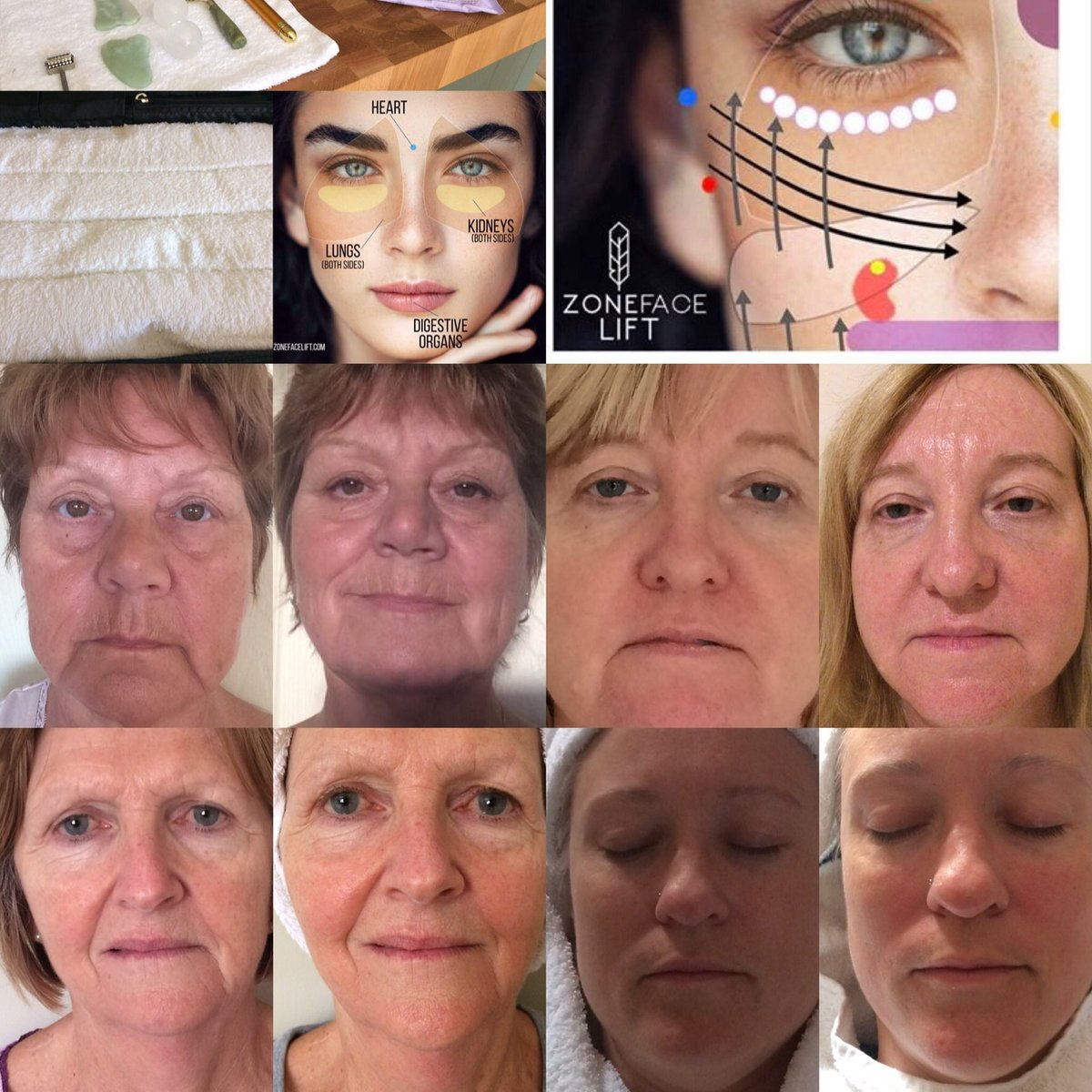 Shoreline_UK's tweet photo. Take 10 years off with the Zone Face Lift- natural, jaw lift, former skin, wrinkle reduction #Heacham #bergmanmethod #facelift #norfolk #nyr https://t.co/TXQdijIswU