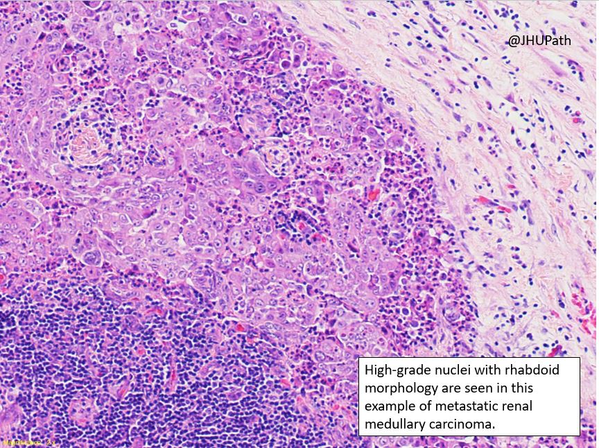Hopkins Pathology on Twitter "Here's the answer for this