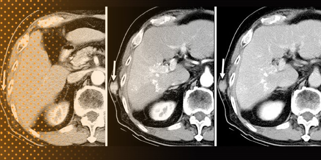 Follow each diagnostic and treatment step in this fast-paced case of a #patient with a #livermass.
bit.ly/2tvl4TT