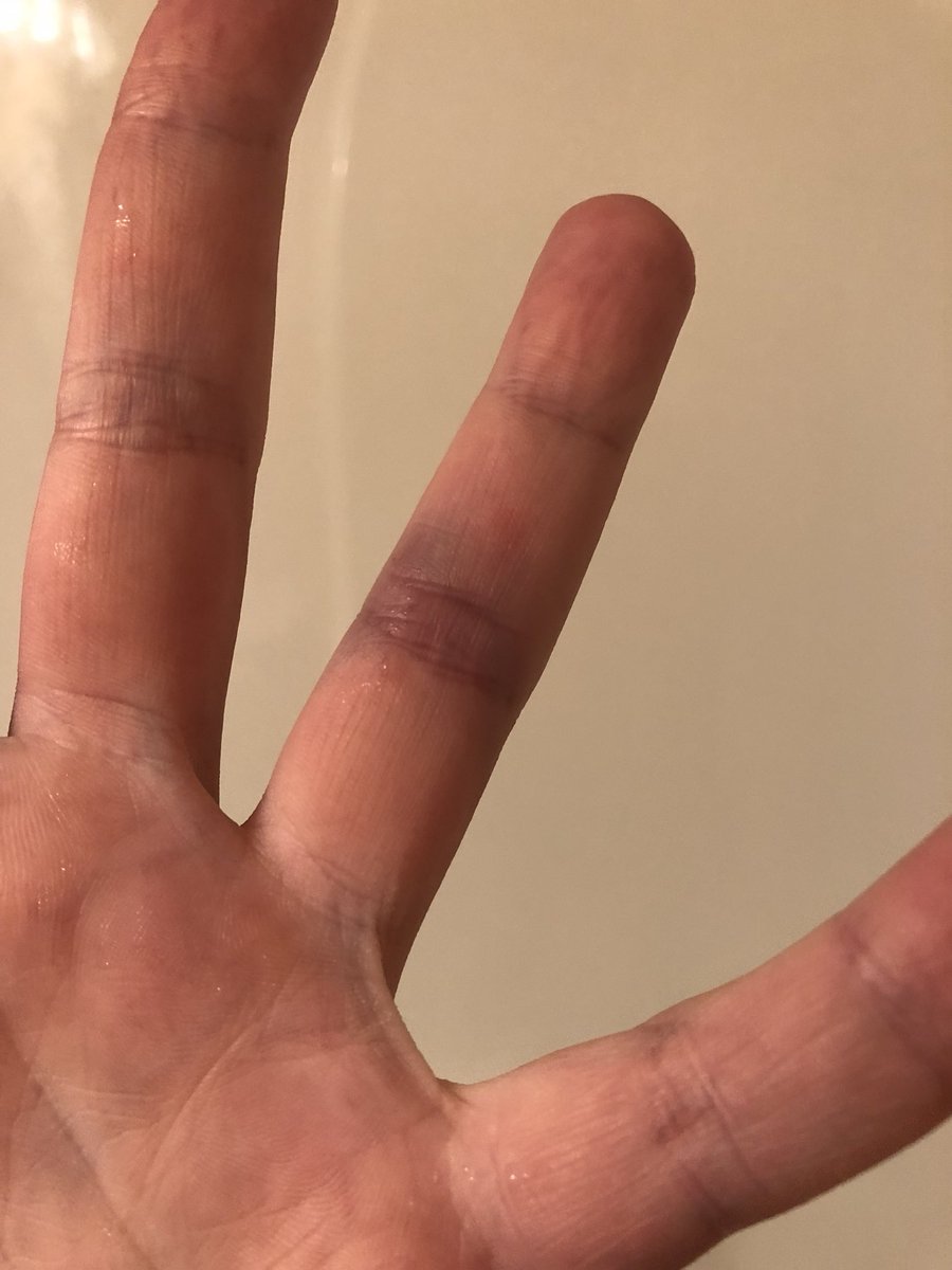 I have this problem that comes and goes. Bursting blood vessels in my fingers. It usually hurts like crazy for about half an hour, then turns purple like a bruise. 

#diagnosethis #help #burstbloodvessel #circulationproblems #whatswrongwithme