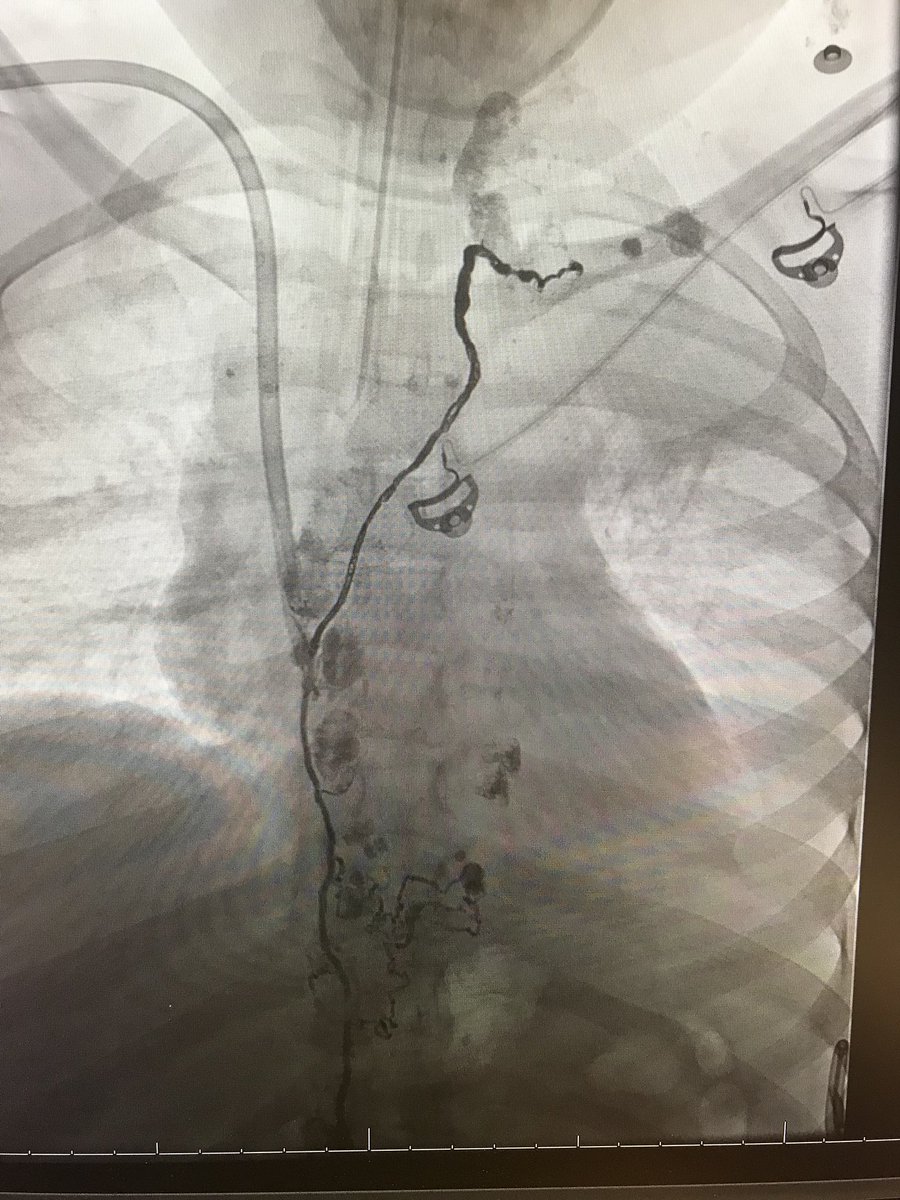 ArizonaVIR's tweet photo. #thoracicduct Thursday here @ArizonaVIR recurrent chylothorax treated with intranodal lymphangiography and thoracic duct embolization with coils/glue. CXR at 1 month clear! Honored to help the great citizens of #Tucson! #lymphatics @Penn_IR @hughmcgregor @woodhead @CHennemeyer https://t.co/vSPmPhBAW3