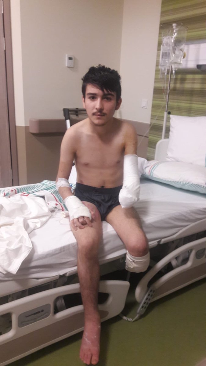 kbraArki's tweet photo. Lütfen yardımcı olur musunuz ? 
Daha 16 Yaşında protez bacağı takılması gerekiyor ama malesefki hiç durumları yok. Bu gençe umut olmak ister misiniz ? 🙏🙏
@haluk_levent @ahbapplatformu @Ahbap_Medya https://t.co/Z8wKqS82oh