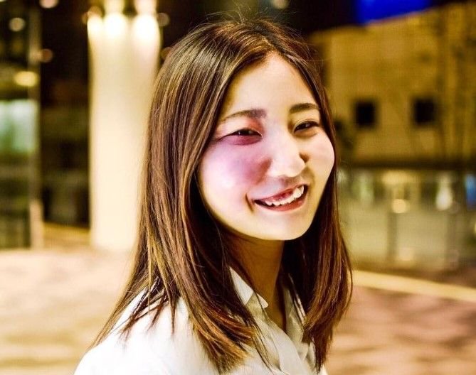 Withnews บนทว ตเตอร 見た目問題 どう向き合う 生まれつき顔の右側にあざのある女子大生が インスタグラムで自らの顔を公開し 大きな反響を呼んでいます なぜ公開したのでしょうか T Co Vxpkdk2v0x Withnews 見た目問題 T Co Withnews บนทว ตเตอร 見た目問題 どう向き合う 生まれつき顔の右側にあざのある女子大生が インスタグラムで自らの顔を公開し 大きな反響を呼んでいます なぜ公開したのでしょうか T Co Vxpkdk2v0x Withnews 見た目問題 T Co