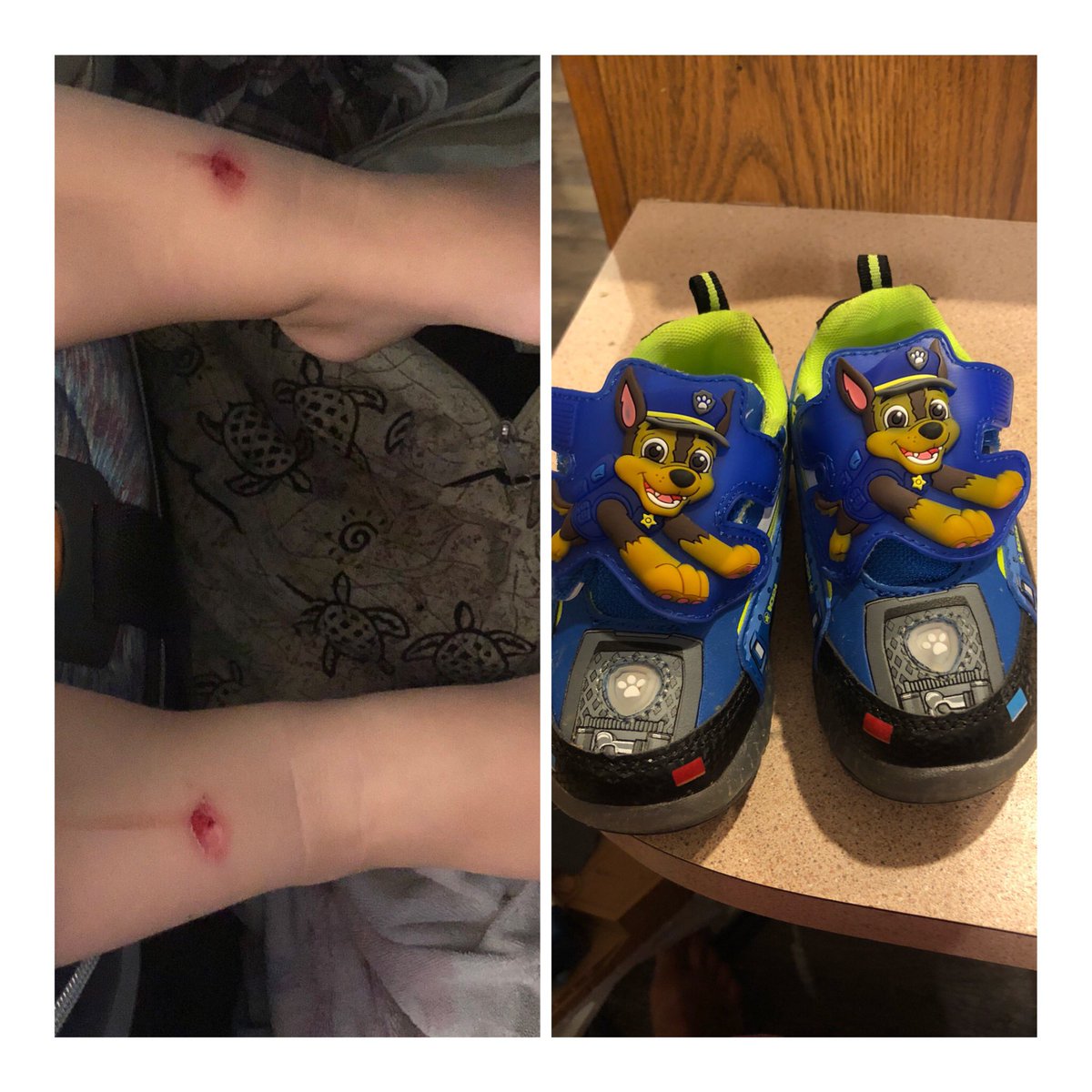 SchoferTravis's tweet photo. Hey @pawpatrol and @Walmart this is what my 2 year olds ankles looked like an hour after wearing these shoes. #epicfail #PawPatrol #walmart https://t.co/j4b2ZDTard