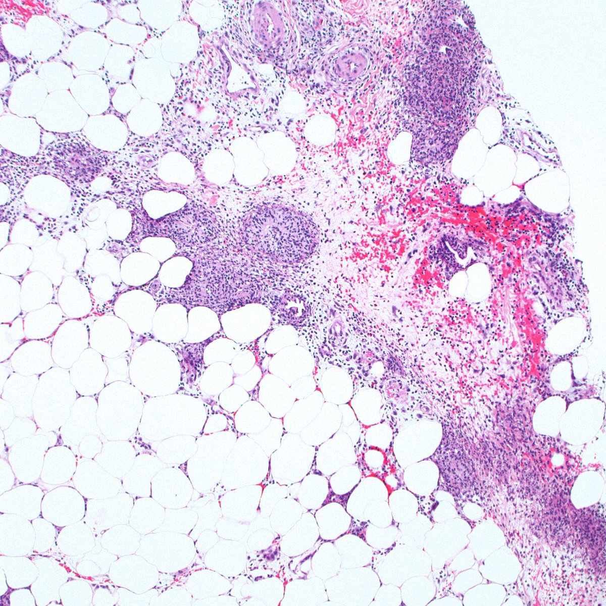 BeverlyPath's tweet photo. Dermpath101: Erythema nodosum with Miescher radial granulomas 
#dermpath #dermatology #surgpath #pathology #pathologists https://t.co/kD1vmTT2qj