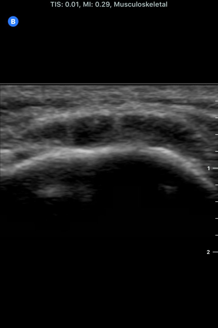 ultrasoundit's tweet photo. Positive #Sonopalpation and sonographic patellar tendonopathy captured on my #ButterflyIQ - ready for more #MSKUS and #Sportsmedicine
@ButterflyNetInc #POCUS #FOAMus #meetIQ https://t.co/494TXOa76a