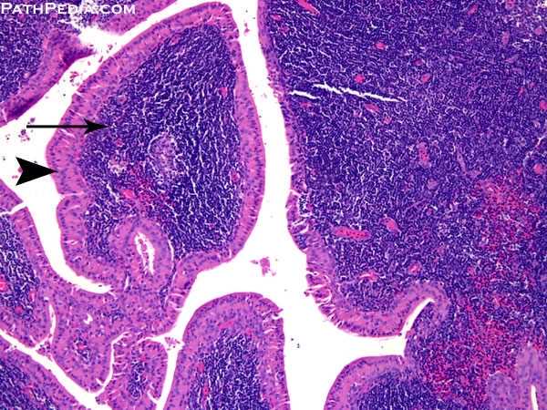 FoodWebinar20's tweet photo. #EuroPath2018
#hcsmsa
https://t.co/K3X78oYUZs 
Starting a series called #slidestories I will post a few microscopic images and you will try to tell a patient story from the images. Please don't post any diagnosis.
This is the first case! Showoff your pathology magic! https://t.co/u5GYlzIVnO