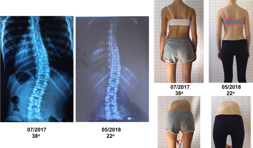 لماذا لا يكفي الفحص السريري وحده لتقيم اعوجاج العمود الفقري؟