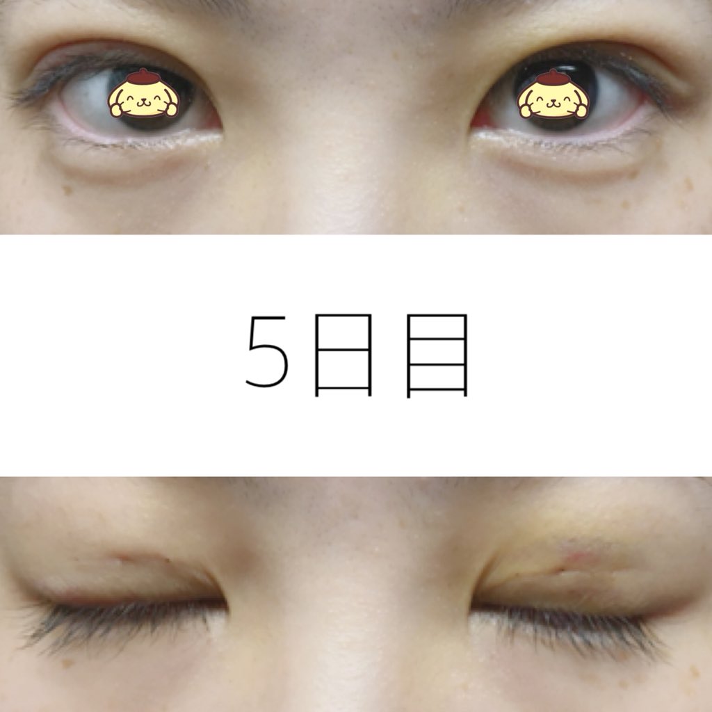 ぼてこ 埋没経過記録 5日目 早くアザ治らないかな アザには温めるのがいいって聞いたことあるけどどうなんだろう 腫れは冷やした方がいいから 温めない方がいいのかな フォーエバー二重術 埋没 T Co 7qpkciikqn Twitter