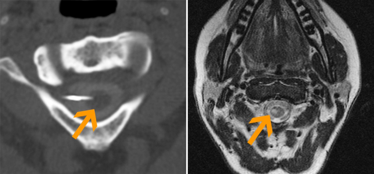 OncoLogNews's tweet photo. Image-Guided Cordotomy for Cancer Pain
Computed tomography–guided cordotomy relieves cancer-related refractory pain
https://t.co/ckq4vl4HKJ
#EndCancer 
#opioidcrisis https://t.co/PPYln0pvh7