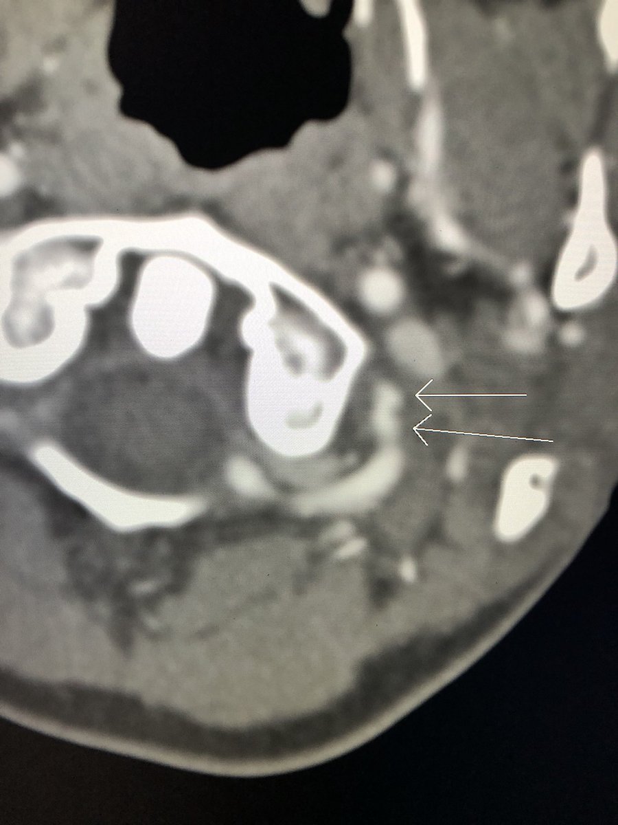Una disección de la arteria vertebral, después de "tronarse" el cuello con un quiropráctico 😱😱😱 vía <a href="/rishisethmd/">Rishi Seth, MD</a>
Por cierto, los quiroprácticos no son #Médicos, y mucho menos, científicos, aunque avalen colchones por aquí y por allá.