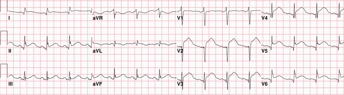 Sam Ghali M D Ecg Of A 60 Year Old Lady Found Down She Is Minimally Responsive Intubated On Scene By Paramedics Bp Is 90 60 Mmhg She S Run Quickly Through The Scanner And