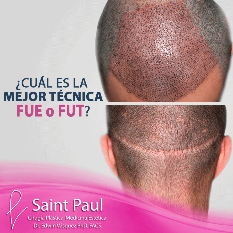 CapilarCenter's tweet image. ¿Cuál es la mejor técnica de Implante Capilar? La técnica #FUE es la más práctica y conveniente para el paciente.
✅Sin dolor después de la cirugía.✅Recuperación rápida.
👉#Agenda tu CITA en línea aquí goo.gl/HbnVvr y recibe S/.30 de descuento en la Consulta