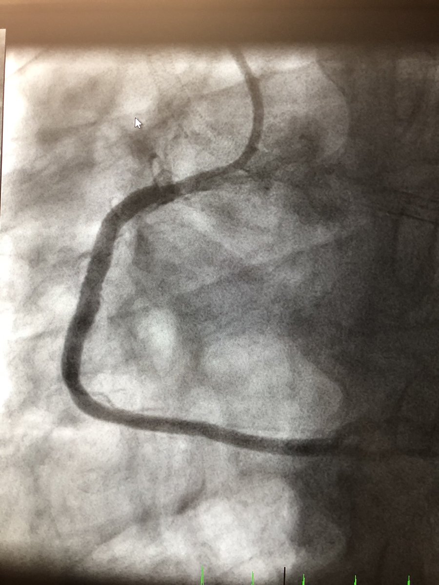 Impella and BAV with Tru Balloon, no pacing. Oribital atherectomy LM-LAD, provisional stenting LM with FKB. OAS of RCA and stenting. Sometimes the pretavr PCI is the hardest part. #impella#hrpci#CSI#truballoon