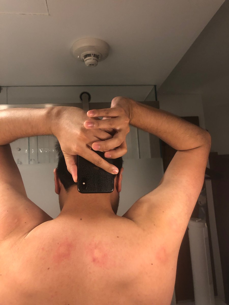 mondobytes's tweet photo. DO NOT AND I MEAN DO NOT!!  Stay at the @ArloHotels in New York!  The worst experience I've ever had, read the whole story: here ----> https://t.co/ohNdji1V2W  Please RT and Share #hotels #newyorkhotels #bedbugs #travel #traveler #trip #adventure #hotel #newyork #hotelroom https://t.co/vwoHaCmhBI