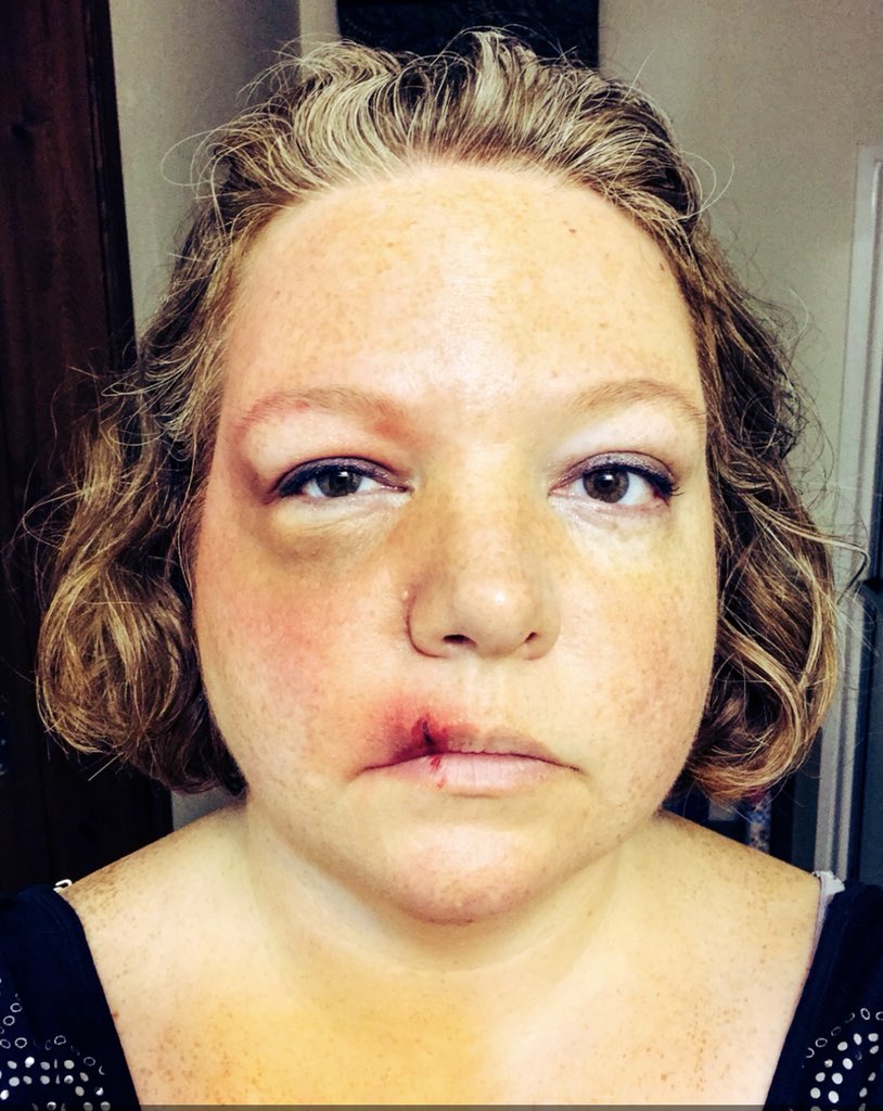 libbitybits's tweet image. Playing around with cuts and bruises. It came out looking pretty real. #makeupartist #specialeffectsmakeup #Halloween #facepaint