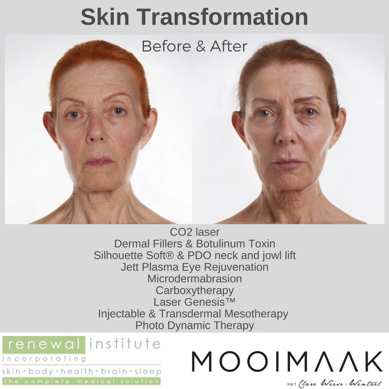 SkinBodyRenewal's tweet photo. #Mooimaak: 😱Én, wat dink jy van die nuwe Coreen? Loer ook gerus hier. 👉 https://t.co/LKvbdobRGg
@clarewiese @kykNETtv #SkinRenewalSA #Mooimaak2 #Lamelle https://t.co/A97eF9GadC