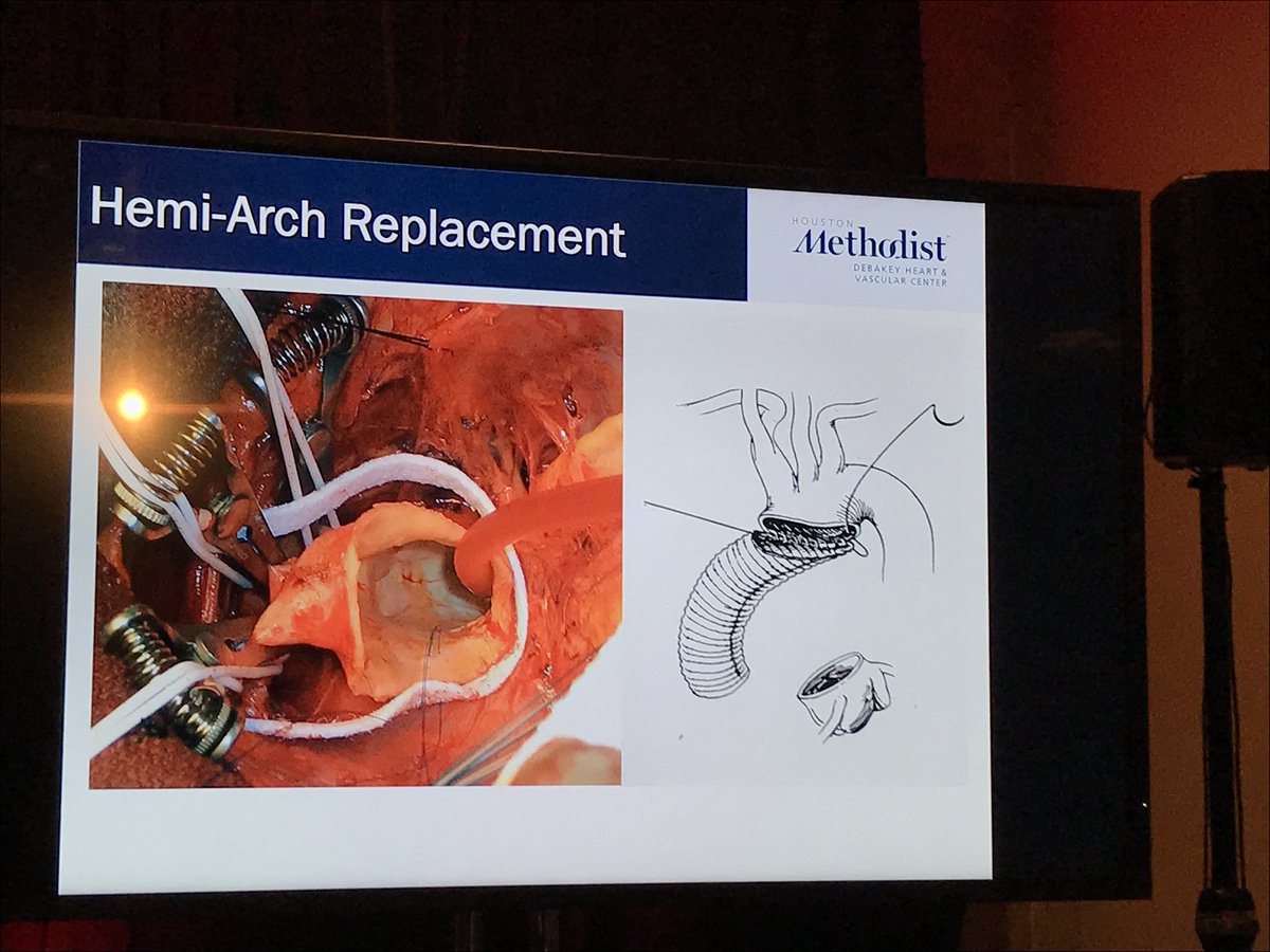 HuieLin's tweet photo. Cardiology fellows: You can join us now for the third day of #CVBootCamp2018 online LIVE and even ask questions: https://t.co/87oIU7okij Right now DrMacGillivray on Thoracic Aortic Disease @sts_CTsurgery #ACCFIT https://t.co/lTqjvq84Ty