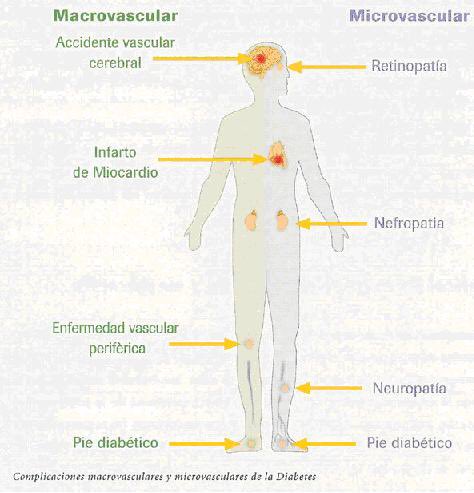 enfermedad macrovascular vs microvascular en diabetes