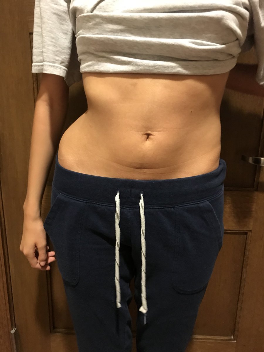camrynhoweth's tweet photo. I love having two curves again #beforeandafter https://t.co/XI24Qw5FKI