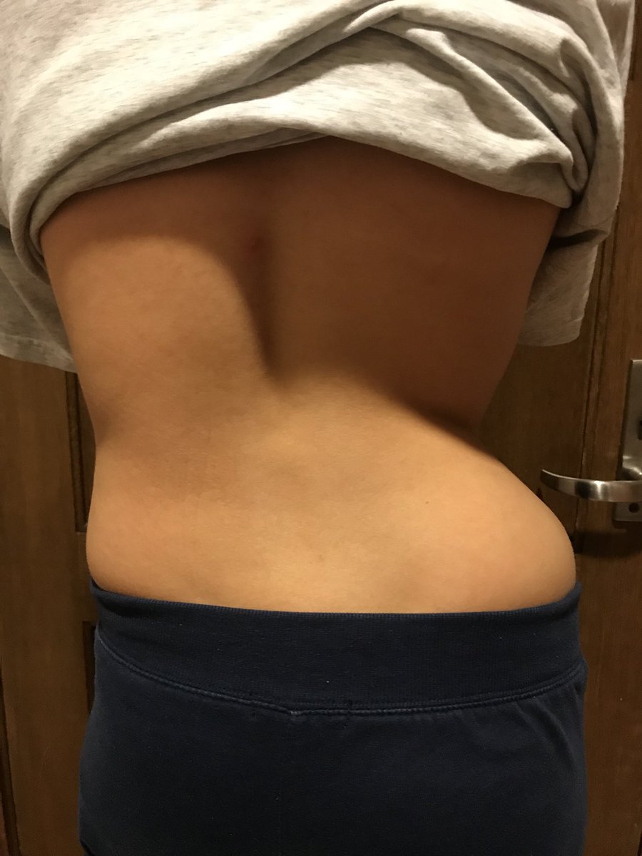 camrynhoweth's tweet photo. I love having two curves again #beforeandafter https://t.co/XI24Qw5FKI
