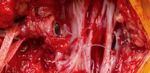 Are your graft materials failing? Report it and have it analysed! "Commentary on #EJVESCoupdOeil “Spontaneous Non-anastomotic Rupture of Axillo-femoral Bypass”" <a href="/vascularis/">Arindam Chaudhuri</a> <a href="/NChakfe/">Nabil CHAKFE</a> @geprovas doi.org/10.1016/j.ejvs…