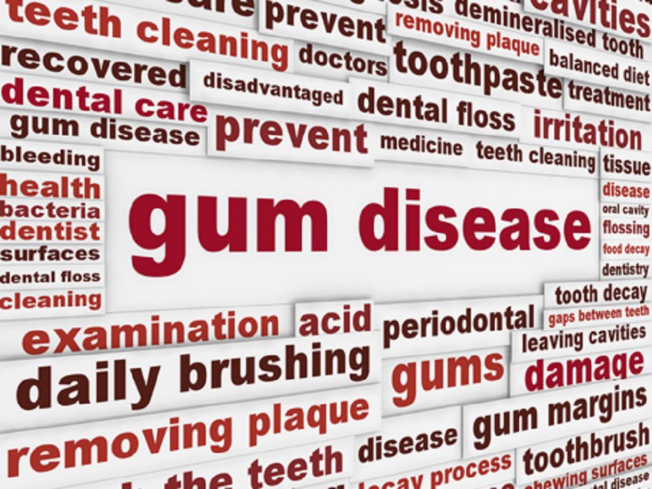 AmerDentalAssn's tweet photo. Gum disease is an infection of the tissues that surround and support your teeth. It is a major cause of tooth loss in adults. See your dentist if you suspect you have gum disease because the sooner you treat it, the better. https://t.co/P2cID3iiPa https://t.co/DjR8pvpJF3