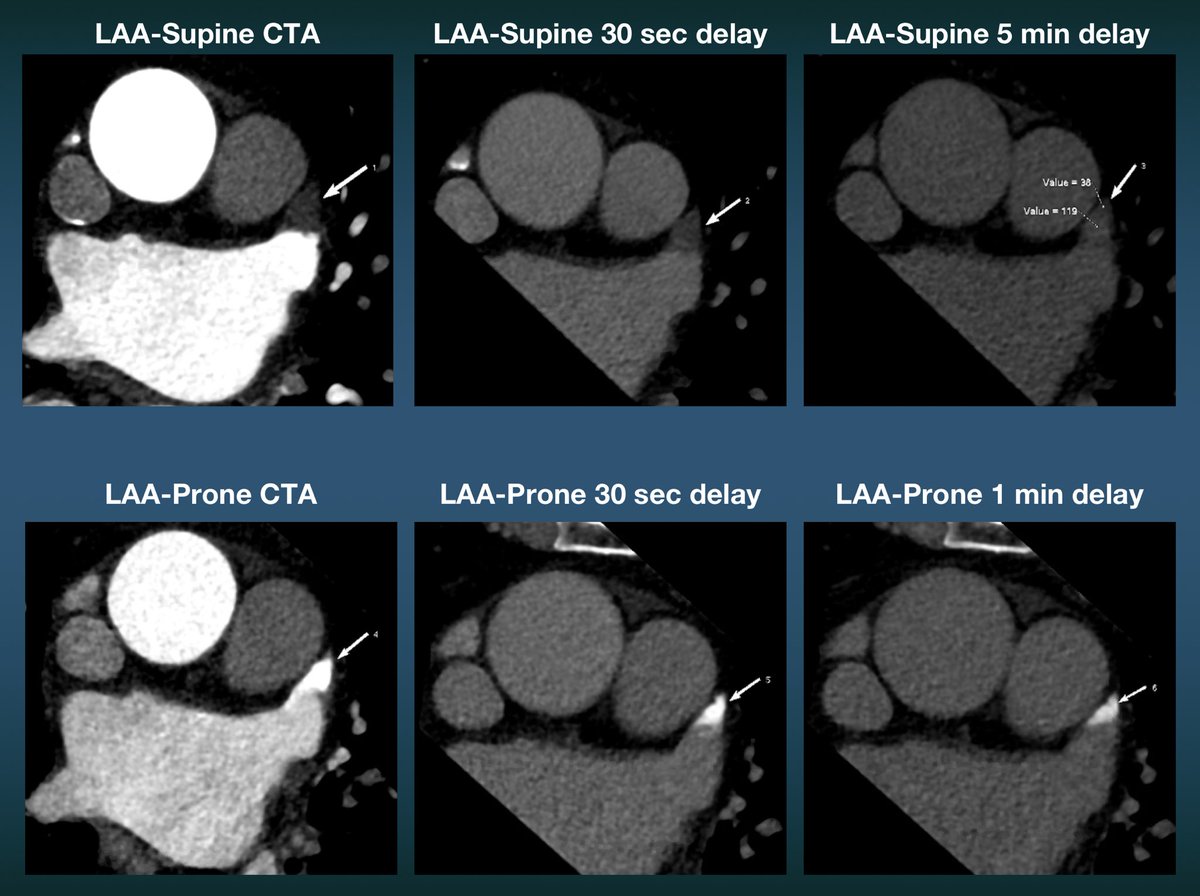 Markus Scherer (@markusscherermd) on Twitter photo LA Appendage filling defect/on CTA and delayed phase supine images. Prone CTA in same setting definitively ruled out thrombus with opposite effect of persistent hyperenhancement
<a href="/Heart_SCCT/">Heart_SCCT</a> #Cardiotwitter #LAAppendage #CTA #CardiacCT LA Appendage filling defect/on CTA and delayed phase supine images. Prone CTA in same setting definitively ruled out thrombus with opposite effect of persistent hyperenhancement
<a href="/Heart_SCCT/">Heart_SCCT</a> #Cardiotwitter #LAAppendage #CTA #CardiacCT