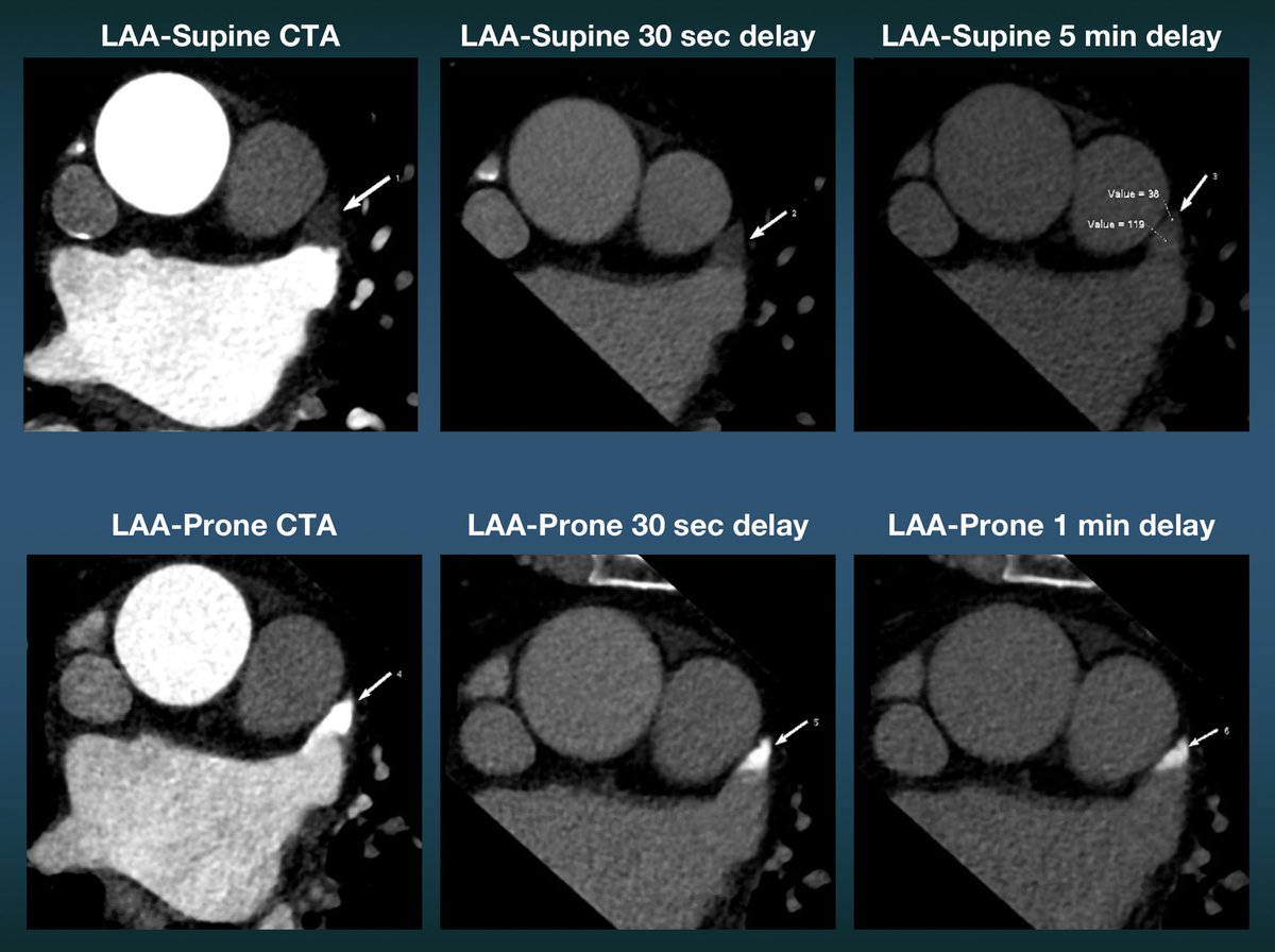 LA Appendage filling defect/on CTA and delayed phase supine images. Prone CTA in same setting definitively ruled out thrombus with opposite effect of persistent hyperenhancement @Heart_SCCT #Cardiotwitter #LAAppendage #CTA #CardiacCT