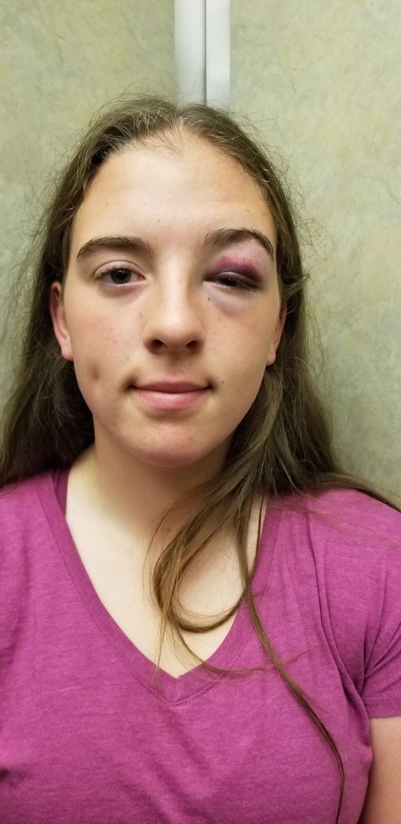 cookmumma's tweet photo. When a softball isn't as soft as everyone thinks.π Still went on to play 4 games.πͺ #facemasks #thatsnotmakeup #shesgoingtokillmeforpostingtgis #PWSABantamII @UTMFastpitch https://t.co/6MRkSMLxyp