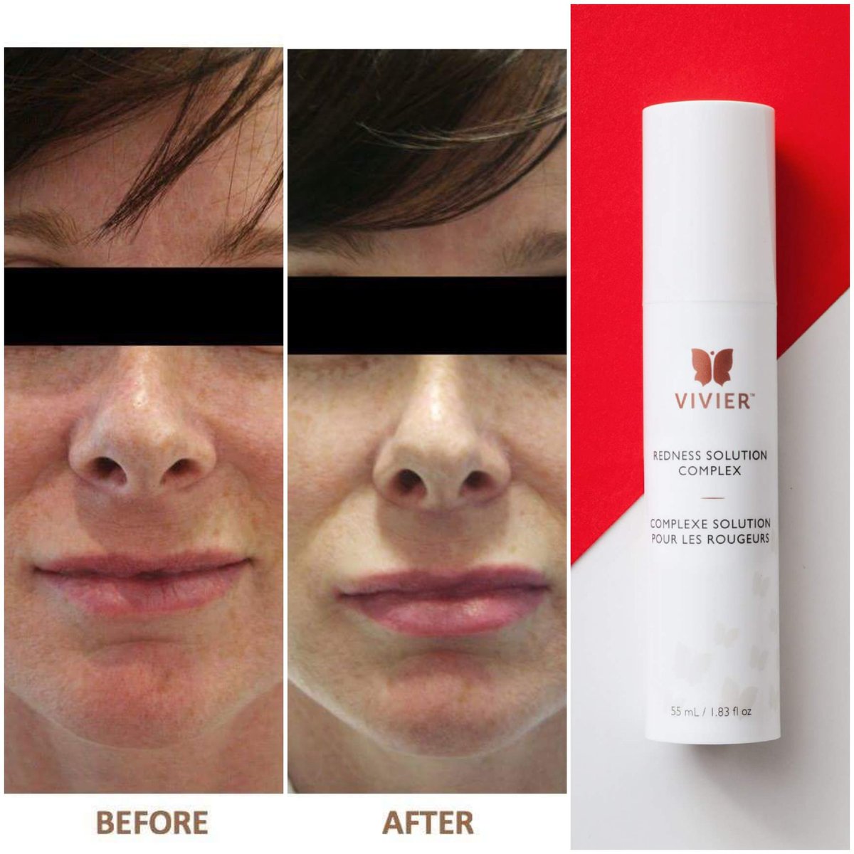 Dermedix's tweet photo. Calm and soothe the appearance of redness by moisturizing the skin with @vivierskin Redness Solution Complex, formulated with Peptides and Red Algae Extract. See the transformation firsthand after only 4 weeks of application. #vivierskin #skincareroutine #beforeandafter https://t.co/uyk8qQhr6B
