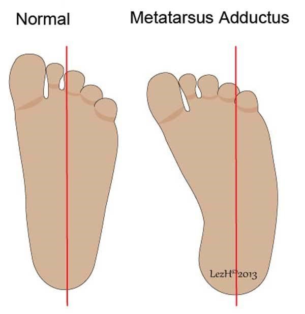 TheChildrensPod's tweet photo. Keeping a close eye on your child's feet is so important. Our newest blog post looks at Metatarsus Adductus, a common foot condition that turns the forefoot inwards. Definitely worth the read to know what it looks like and how to fix it: https://t.co/O3ZVw1Gv7V 👣 https://t.co/MTcTo5hbti