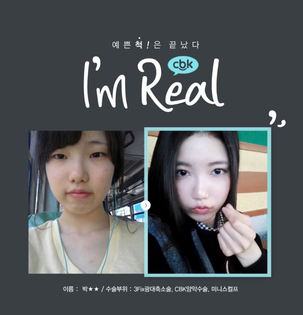 韓国整形 Cbk チェボンギュン院長 Cbk美容外科 可愛い子ぶり は終わった I M Real 顎なしで顎にシワがよってしまっていた彼女 頬骨手術 両顎手術 ミニスカルプ 手術前 6ヶ月以降 T Co Qi0wowyirw Twitter