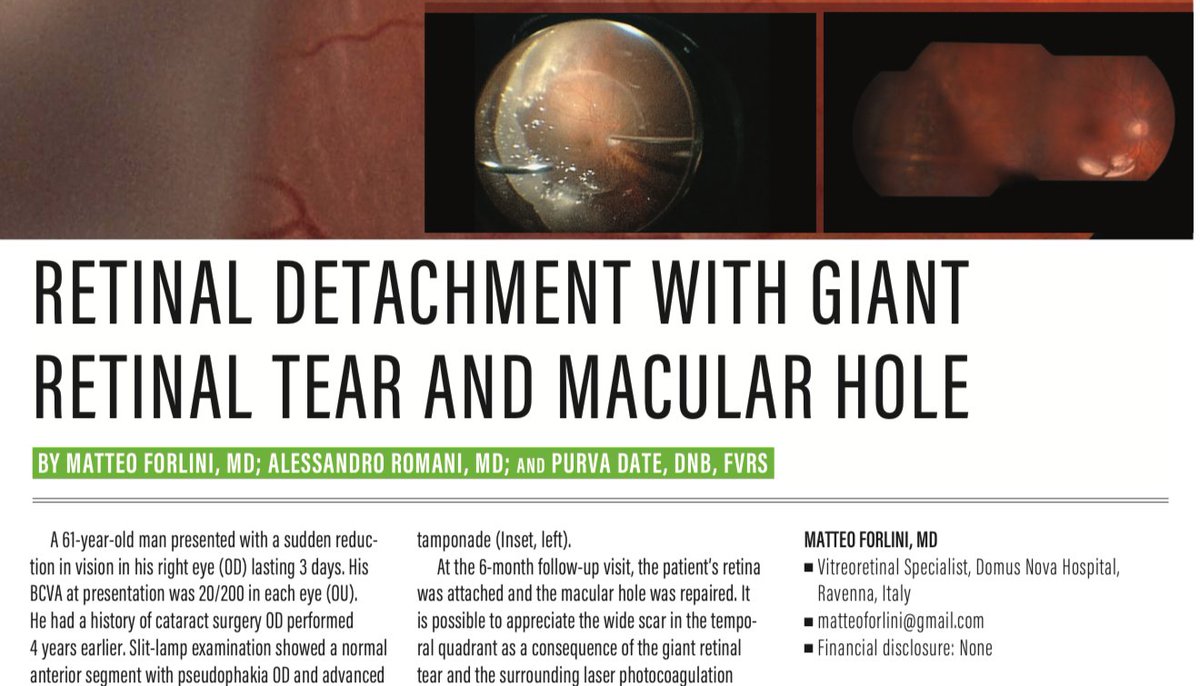 RetinaToday's tweet photo. Take a look at these great images and case description of a #RetinalDetachment with #GiantRetinalTear and #MacularHole: https://t.co/i2jN7vDfJR #VisuallySpeaking https://t.co/LH7AGxh6yX