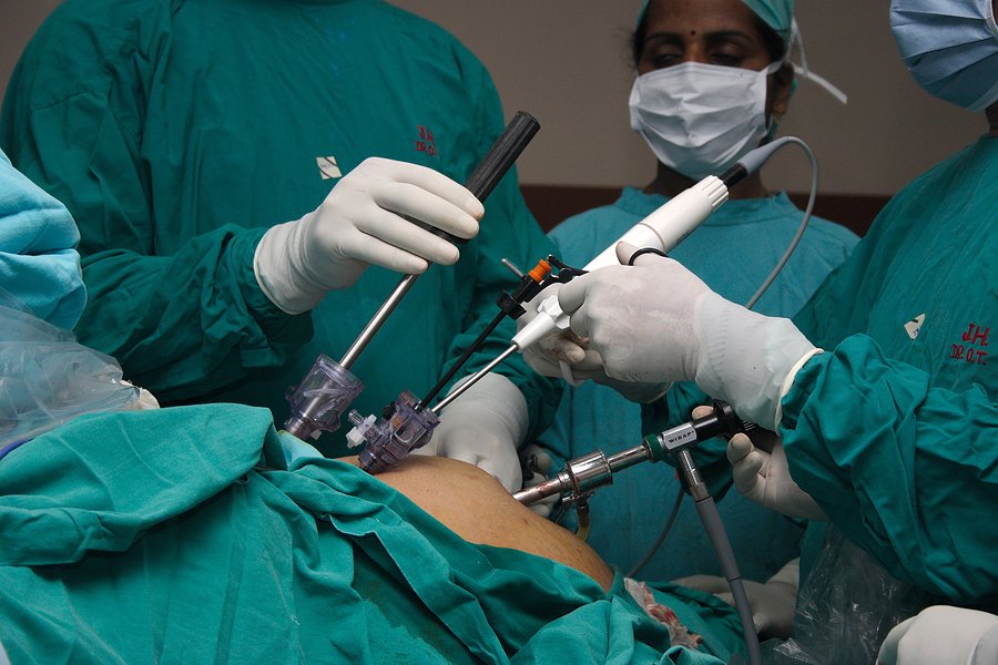 Conversion to SADI valid alternative to RYGB after failed LSG #bariatricsurgery #obesity bariatricnews.net/?q=news/113200…