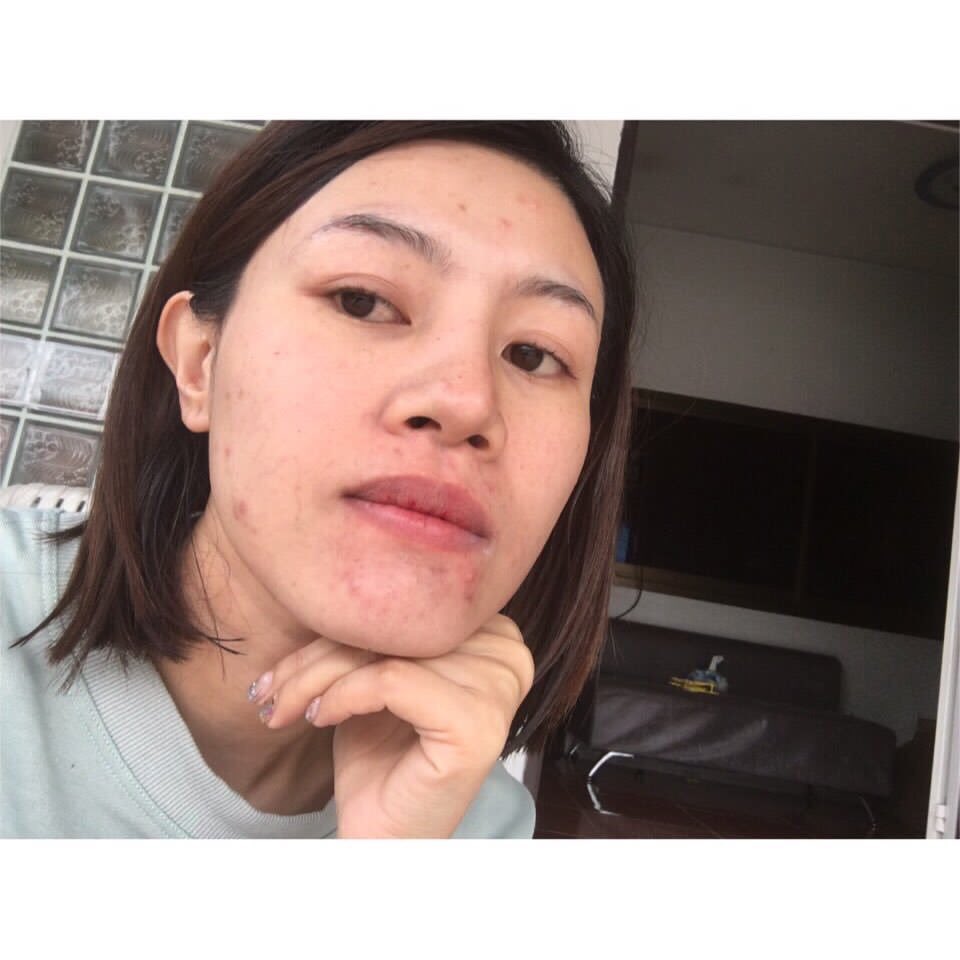 Mananya85293992's tweet image. ของจริงโว้ยยยย กิน#dwcollagen ไปเดือนเดียวจริงๆ  ประมาณ4 กล่อง  คือแบบ สิวอักเสบยุบ รอบสิวจาง  หน้าเนียนขึ้น แบบเนียนละเอียด  คือสิวหายไปเยอะมากๆ อันนี้ปลื้มมากจริงๆ  อยากเอามาแชร์ให้คนเป็นสิวคะ  ไปหาซื้อมาทานนะคะ  ชื่อว่า dwcollagen หน้ากล่องรูปแอปเปิ้ลสีแดงคะ   #O2soSTRONG