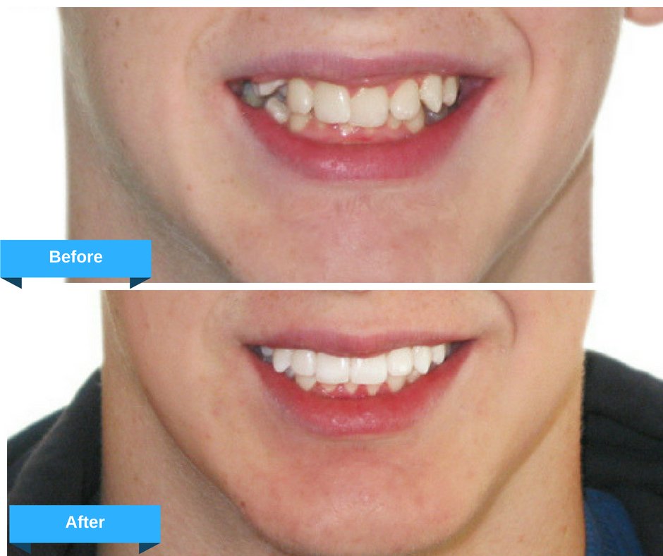 Visit #SmileAvenueFamilyDentistry today to get the best treatment for crooked, spaced or misaligned teeth. Get a brand new smile with #6MonthSmiles. They are comfortable, effective and provide amazing results! 😁
#6monthsmile #misalignedteeth #dentistry #clearbraces