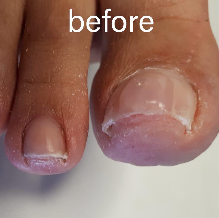 TheWorksDublin's tweet photo. Suffering from an ingrown toenail? We offer effective, non-invasive #treatment Arkada’s Method, that shows results after 1 visit. Call us at (01) 490 7178 &amp; book your appointment now. #ingrownnails #podology #happyfeet #theworks #theworkssalon #beauty #arkadamethod #dublin https://t.co/XRcuxd356R