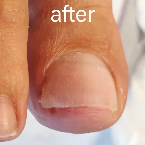 Suffering from an ingrown toenail? We offer effective, non-invasive #treatment Arkada’s Method, that shows results after 1 visit. Call us at (01) 490 7178 &amp; book your appointment now. #ingrownnails #podology #happyfeet #theworks #theworkssalon #beauty #arkadamethod #dublin